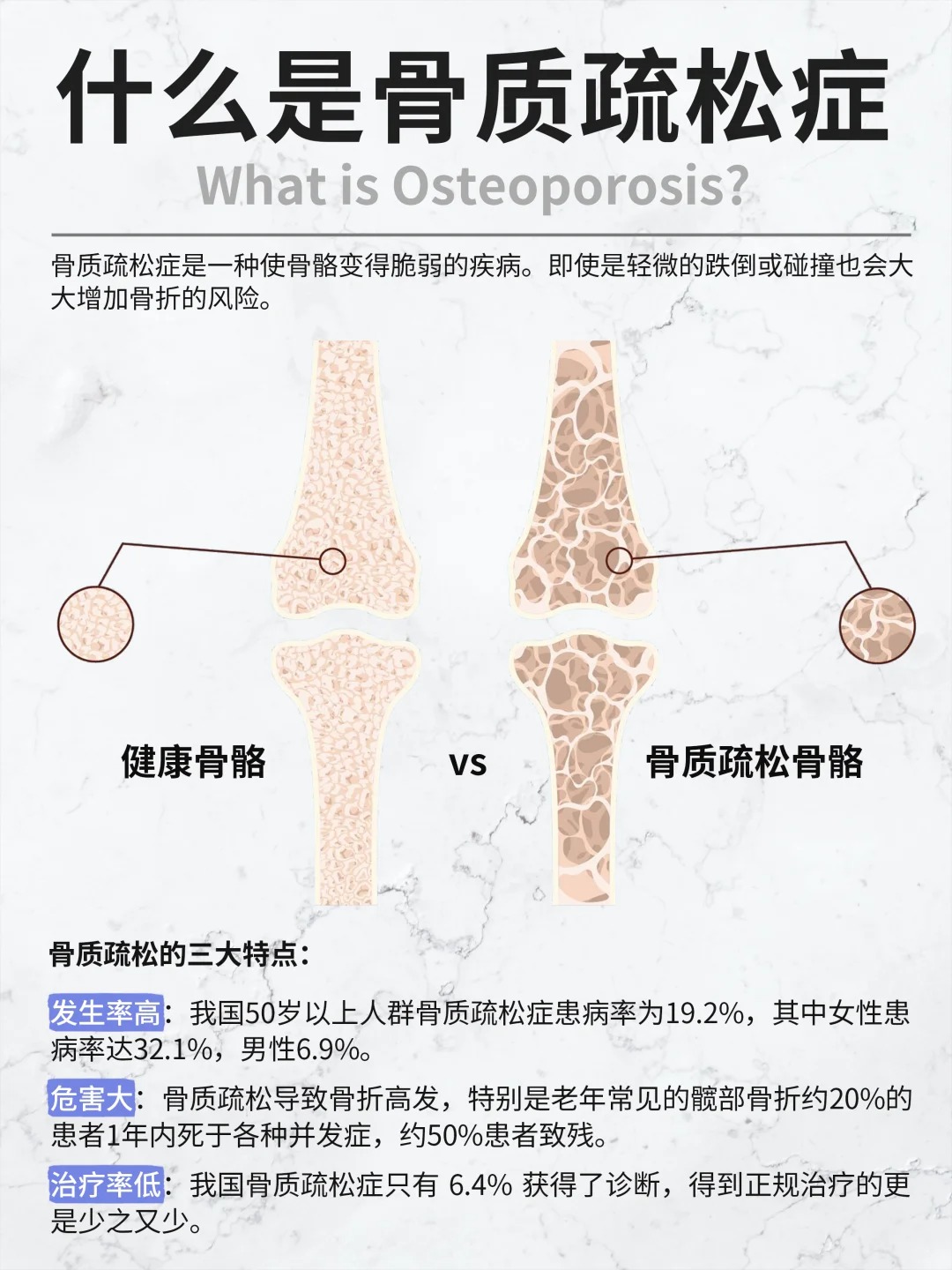 骨质疏松是名副其实的“沉默杀手”，早期几乎毫无症状。。许多人直到意外骨折，才惊觉骨骼早已悄悄变脆——此时干预为时已晚❗。定期检查 + 提前养护，才是防患未然的根本！。👉 推荐日常补充【骨胶原蛋白肽粉】从容守护骨健康！